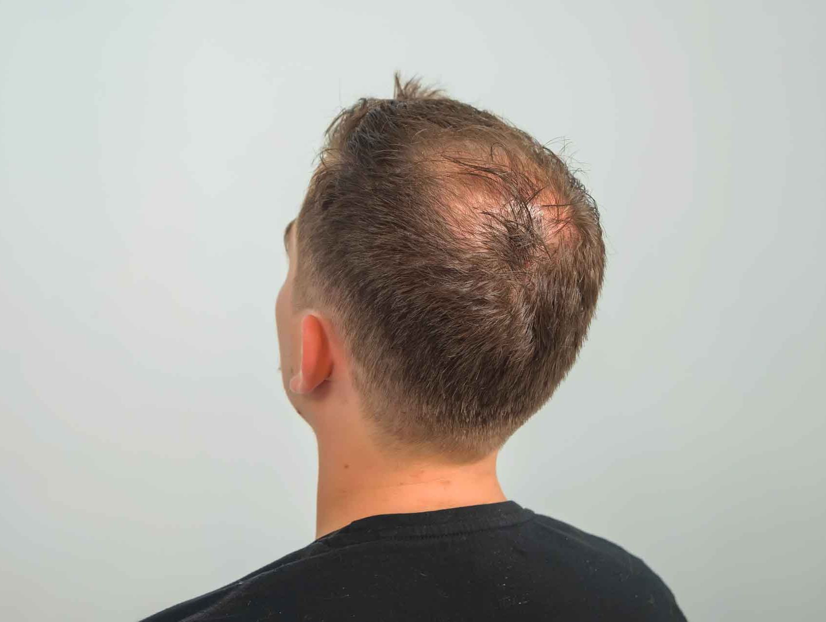 Male Pattern Baldness: